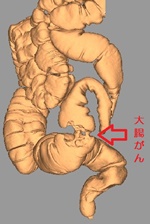 大腸CT